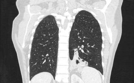 Pulmonary Sequestration Image Radiopaedia Org