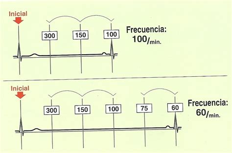 Calculo De Frecuencia Cardiaca En Ecg Ritmo Irregular