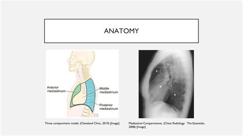 Mediastinal Masses Surgery 101