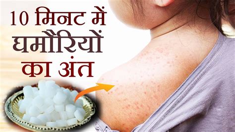 घमौरियों से छुटकारा पाने का गज़ब तरीका Home Remedies For Prickly