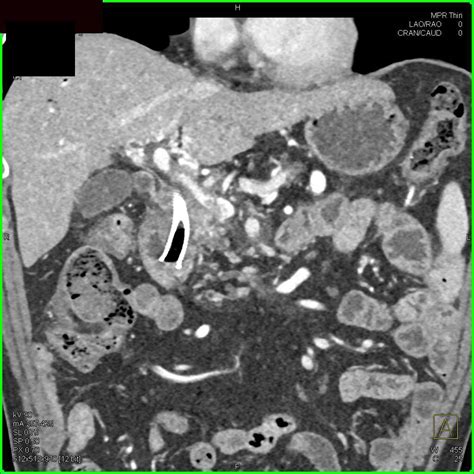 Pancreatic Cancer Encases The Portal Vein And The Superior Mesenteric