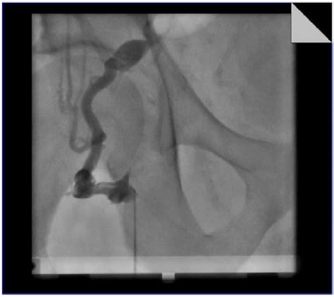 Right Femoral Vein Angiogram Demonstrating Total Chronic Occlusion With Download Scientific