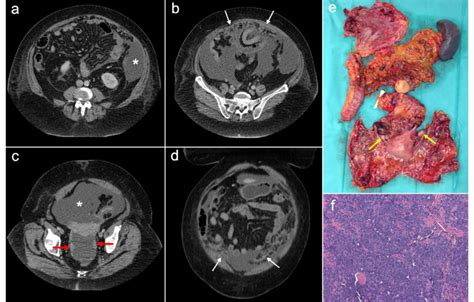 Primary Peritoneal Serous Carcinoma In A Year Old Woman With