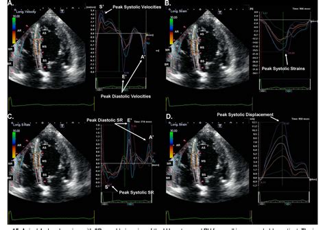 Assessment Of The Right Ventricle By Echocardiography A Primer For