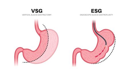 Endoskopische H Lsen Gastroplastie Und Gastrektomie Operation