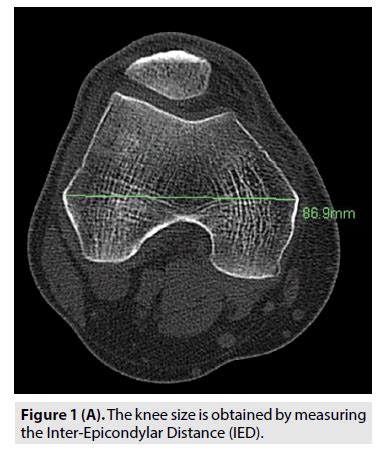 Measurement Of Tibial Tuberosity Trochlear Groove Distance In An