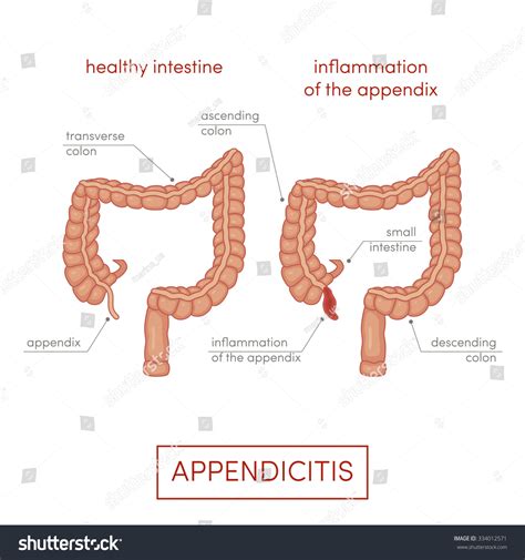 Vektor Stok Appendicitis Inflammation Appendix Cartoon Vector