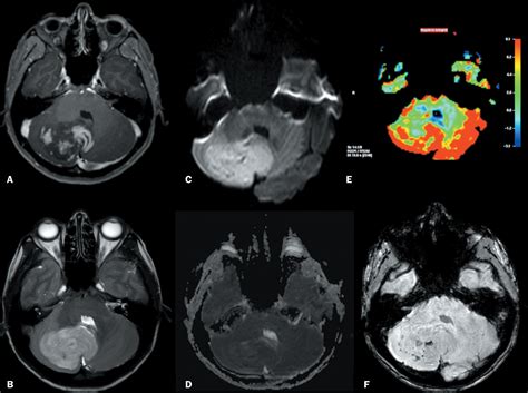 Scielo Brasil Common And Uncommon Neuroimaging Manifestations Of