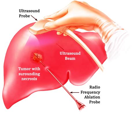 Liver Tumor Dr Pradeep Muley Md Senior Consultant Interventional Radiologist