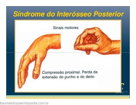 Síndrome Do Supinador Traumatologia E Ortopedia