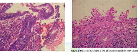 Figure 2 From The Differentiation Of Amebic Colitis From Inflammatory Bowel Disease On