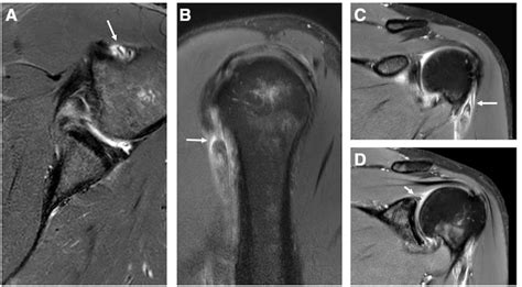 Combined Long Head Of Biceps Anchor Avulsion With Anterior Dislocation Of The Shoulder An