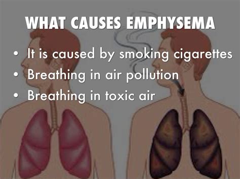 Emphysema Respiratory System Disease By Jamesconway