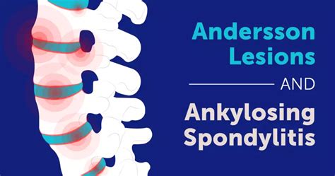 Andersson Lesions And Ankylosing Spondylitis Myspondylitisteam