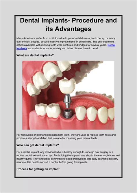 Ppt Dental Implants Procedure And Its Advantages Powerpoint