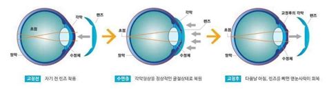 드림렌즈 시력교정 클리닉 아이숲안과