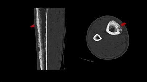 Bone Involvement In Secondary Syphilis Proliferative Periostitis And