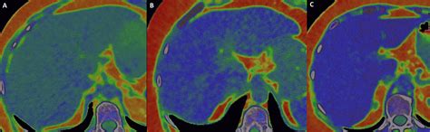 Liver Fat Quantification In Photon Counting Ct In Head To Head