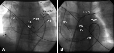 Epicardial Interventions In Electrophysiology Circulation