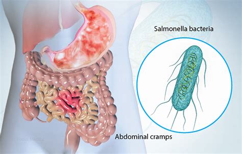 Health Condition : Symptoms, Causes, Treatment and More