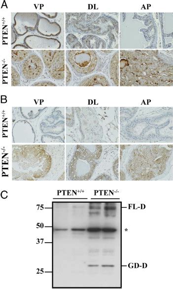 Activation Of Pdgf D Pdgfr In Prostate Tumors In Pten Mice A And