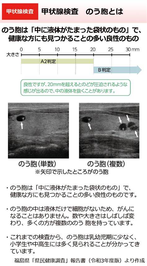 環境省甲状腺検査 のう胞とは