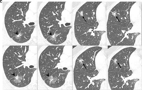 A Novel Algorithm To Differentiate Between Multiple Primary Lung Cancers And Intrapulmonary