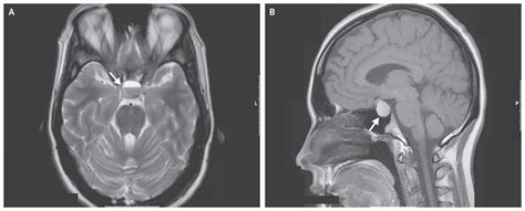 Tumor: Pituitary Tumors