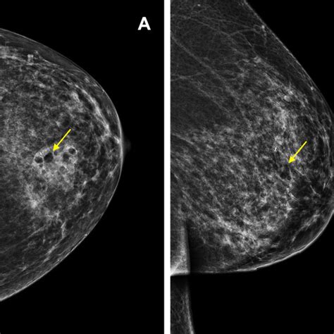 Left Breast Screening Mammogram Craniocaudal A And Mediolateral B