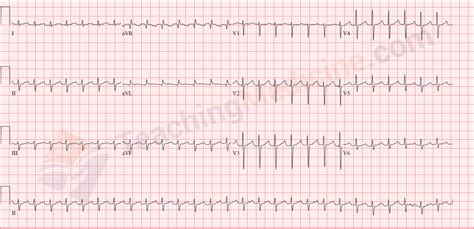 12 Lead ECG Sinus Tachycardia