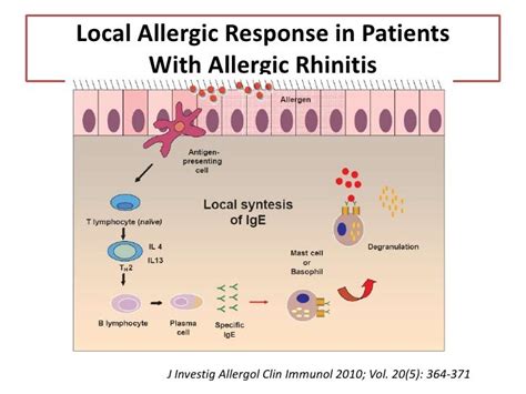 Local Allergic Rhinitis