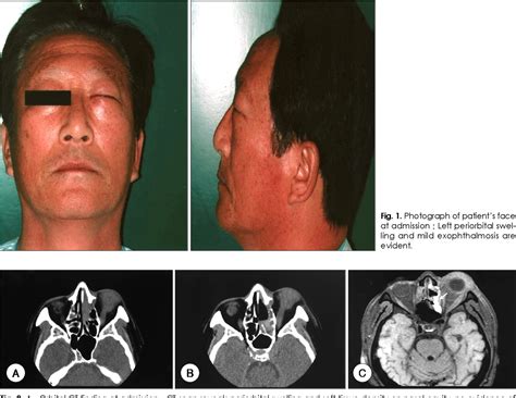 [PDF] A Case of NK/T Cell Lymphoma in Sinonasal Tract | Semantic Scholar