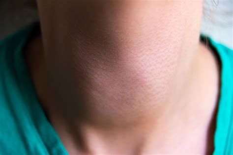 Faits et statistiques sur lhyperthyroïdie ce que vous devez savoir