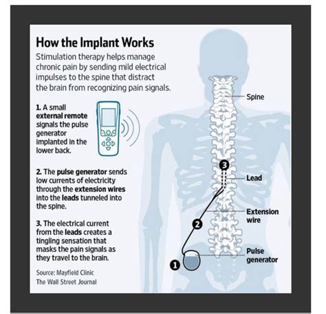 Spinal Cord Stimulation – Paradigm Family Health