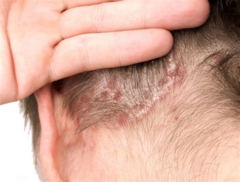 Psoriasi Del Cuoio Capelluto Sintomi E Rimedi Derma Point