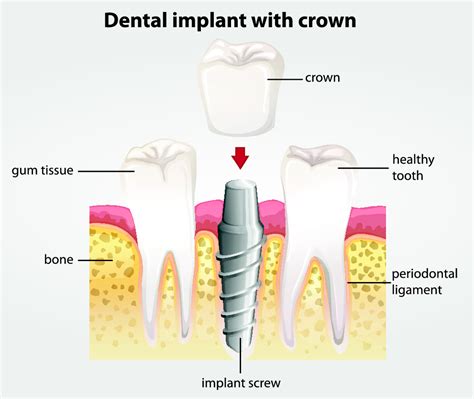 Dentist 53214 | What to Do if You Damage the Crown of Your Implant