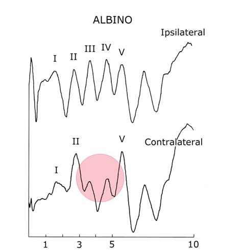 Figure 25 Auditory Brainstem Response ABR Recorded Webvision