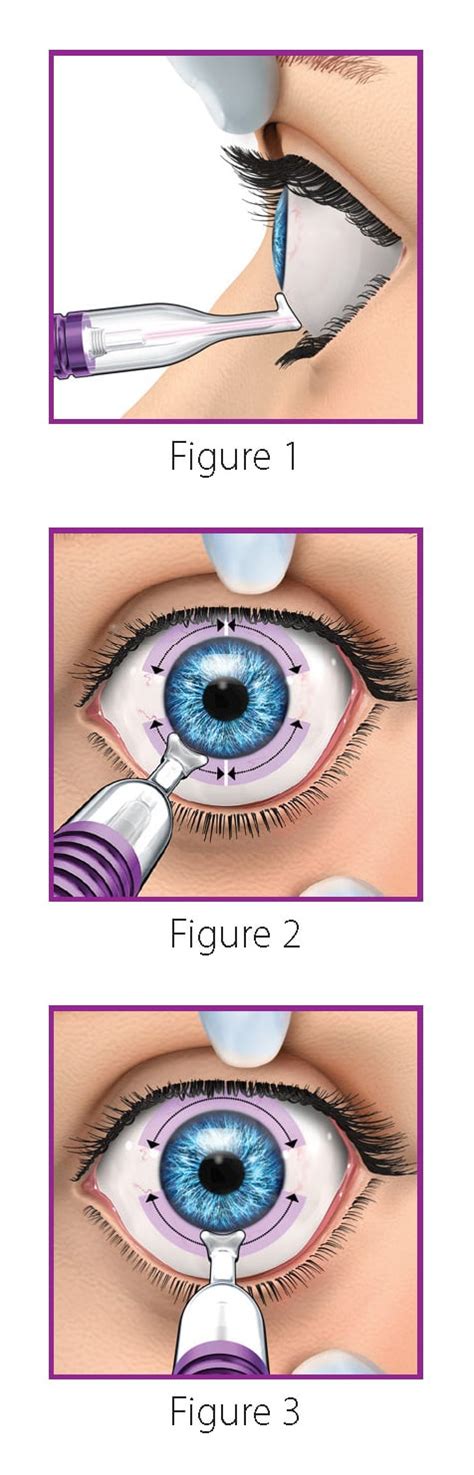 MicroPulse P3 Device For Non Incisional Glaucoma Therapy