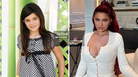 Kylie Jenner Before and After Photos - Has She Had Plastic Surgery?