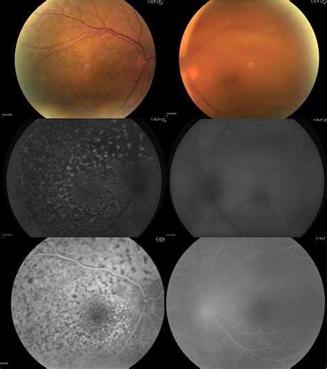 Diagnostic Criteria For Primary Ocular Lymphoma Ophthalmology