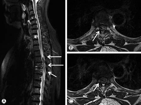 Abnormal Thoracic Spine Mri