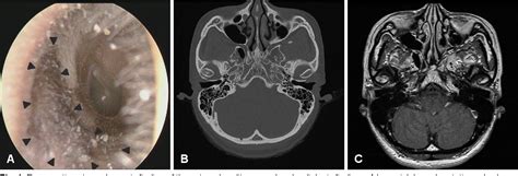 Figure 1 From A Case Of Squamous Cell Carcinoma In Situ Occurred In The