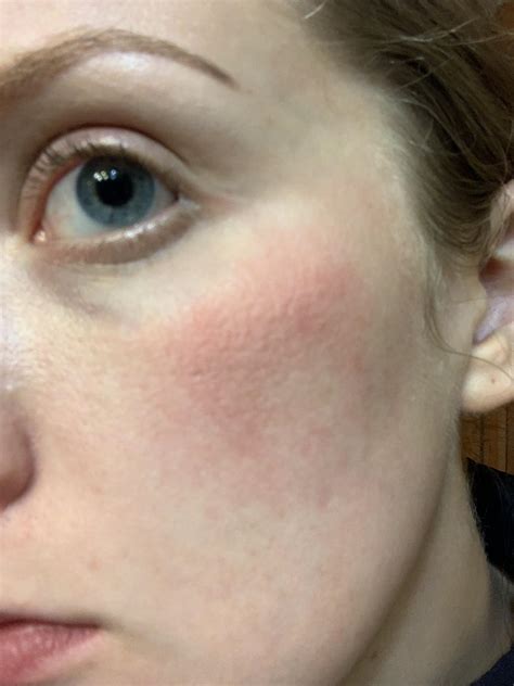 [skin concerns] Superficial frostbite advice? : r/SkincareAddiction