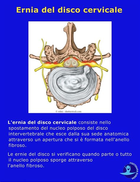 Ernia Del Disco Cervicale I Sintomi Test E La Cura Fisioterapia