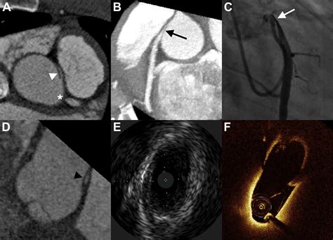 Multimodality Imaging Of An Anomalous Connection Of The Right Coronary