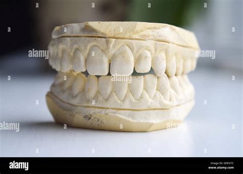 Plaster Impression Of Teeth With Small Gap In Front Teeth Diastema