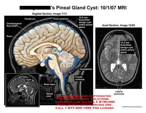 Pineal Gland Cyst Mri