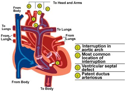 Interrupted Aortic Arch | CS Mott Children's Hospital | Michigan Medicine