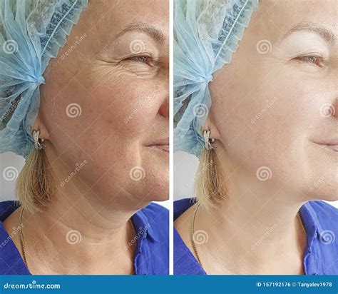 To Remove Wrinkles From Neck Clearance