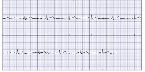 New to AFIB. Just had my first "episode" a few weeks ago, so now im super sensitive to anything ...